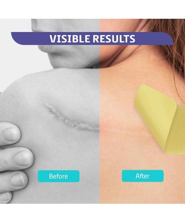 Silicone Scar Removal Sheets 2'' x 3'' - 5 Pack for Surgical, Burn, Acne, and Keloids Scars - Buy Online on GoSupps.com