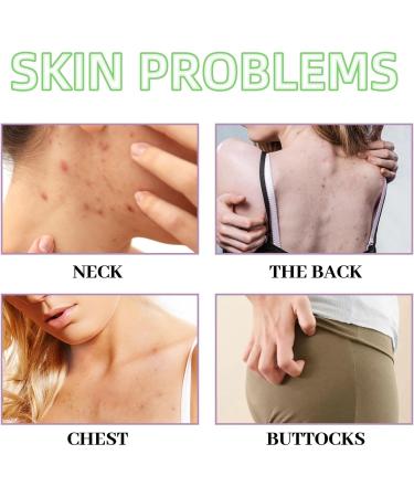 Back Acne Treatment Spray Acne Treatment Spray Acne Moisturiser for Back Body Body Acne Treatment Acne Back Treatment Back Spray Acne Body Acne Spray Back Acne Treatment Acne Body Spray 120ml - Buy Online on GoSupps.com