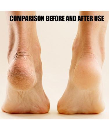 Electric Callus Remover | Portable Electronic Foot File Pedicure | Portable Electronic Pedicure Foot Care for Dead Skin and Pedicure at Home White - Buy Online on GoSupps.com