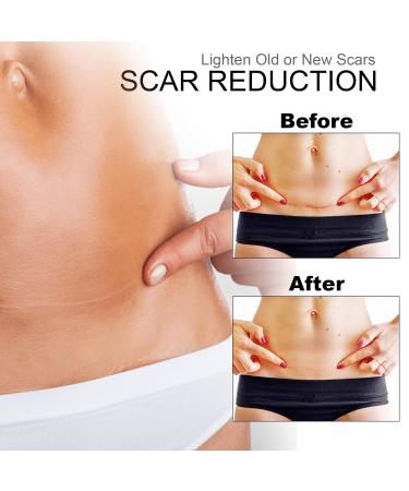 XIRENE 6-Pack Medical Grade Silicone Scar Sheets for Old & New Scars - Reusable & Washable Scar Removal Strips for Acne, C-Section, Keloid, Surgery & Burn - Buy Online on GoSupps.com