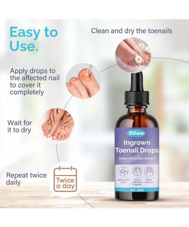 Ingrown Toenail Treatment & Pain Reliever - Softens for Easy Trimming | 30ml - Buy Online on GoSupps.com