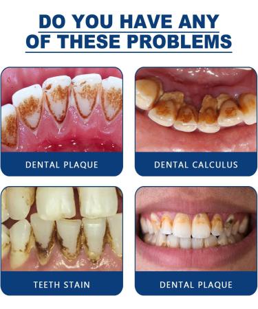  Mnozreo Mnozreo Dental Whitening Spray Dental Tartar Dissolving Spray Tartar Free 30 ml - Buy Online on GoSupps.com