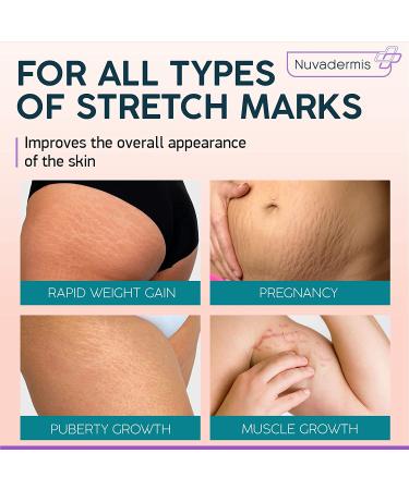 Stretch Mark Cream - Maternity Skin Care with Collagen, Jojoba, and Olive Oil - Prevents and Fades Stretch Marks - Hydrating Belly Lotion for Pregnant Women - 4 oz - Buy Online on GoSupps.com