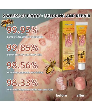 EasPowest Youth Bee New Zealand Professional Bee Venom Psoriasis Treatment Cream Soothing Moisturizing Psoriasis Cream (2PCS) - Buy Online on GoSupps.com
