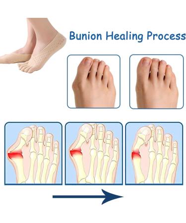 Bunion Relief Socks Projoint Antibunions Health Sock - Bunion Corrector for Women and Men - Black+Skin Tone 12pcs - Buy Online on GoSupps.com