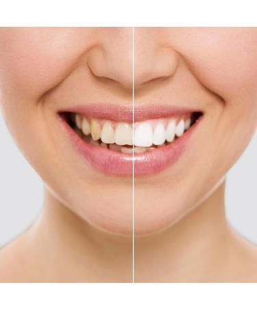 WiTen Tooth Whitening Pin Set - Fast & Safe Enamel-Friendly Whitening | Innovagoods | 2x2 ml Easy Application - Buy Online on GoSupps.com