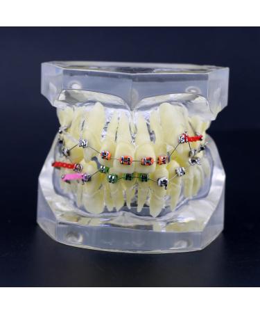 Orthodontic Tooth Model Orthodontic Dental Treatment Malocclusion Model with Brackets Chain Wire