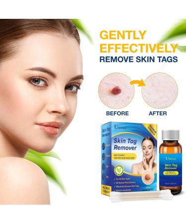 Ulensy Skin Tag Remover - Extra Strength Liquid for Fast, Pain-Free Skin Tag Removal - Natural Plant Extracts, No Scars - Easy Application (Natural Blue) - Buy Online on GoSupps.com