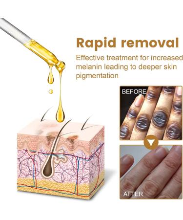 NigriCare Acanthosis Therapy Drops Nigricans for Neck Hands Elbows Dark Spots Pack of 2 - Buy Online on GoSupps.com