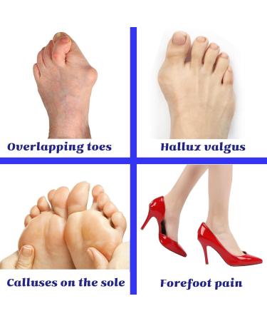 3 Pairs Toe Separators & Metatarsal Pads Soft Breathable Foot Cushions for Blisters Morton s Neuroma Diabetic Feet & Bunion Pain Relief - Perfect for Comfort - Buy Online on GoSupps.com
