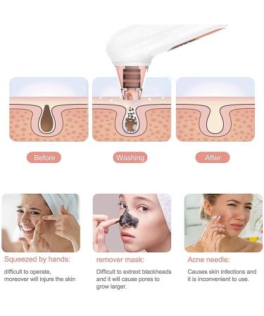 Blackhead Remover Vacuum - Electric Facial Pore Cleaner with 4 Suction Heads for Acne Comedone Extraction and Pimple Removal Kit - Buy Online on GoSupps.com