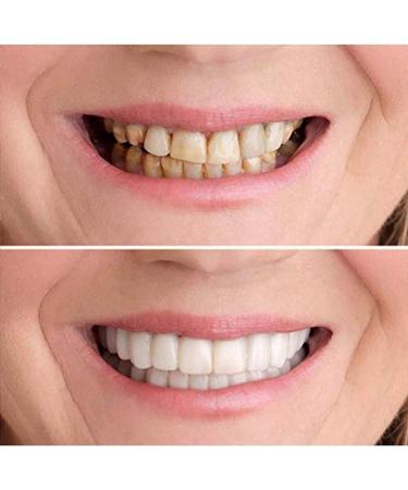 5-Piece Snap-On Cosmetic Dentures | Perfect Smile Tooth Replacement | Comfort-Fit Flex Teeth Whitening for Beautiful Neat Results - Buy Online on GoSupps.com