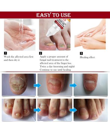 Fungal Nail Treatment Solution - Extra Strong Repair for Toenails & Fingernails - Safe & Effective - 2pcs x 1.00 ml - Buy Online on GoSupps.com