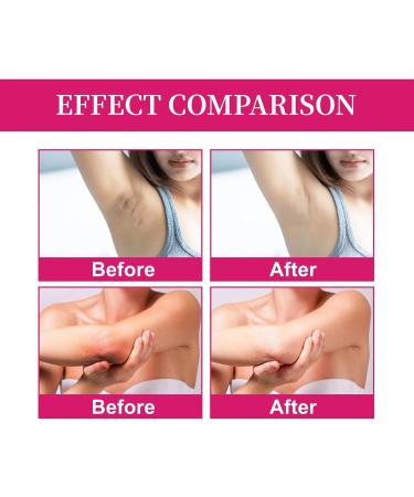 Underarm Whitening Cream - Kojic Acid Whitening Cream - Skin Lightening Cream - Armpit Bleaching Cream - Boost Collagen Skin Whitening Cream - Dark Spot Remover Reduce Odor Restore Complexion Moisture - Buy Online on GoSupps.com