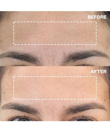 Wrinkles Schminkles Forehead & Under Eye Silicone Patches - Reusable Wrinkle Reducing Set for Smoother Skin Overnight (1 Pair - Buy Online on GoSupps.com