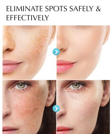 EnaSkin Dark Spot Remover Bundle - Face & Body Hyperpigmentation Treatment Cream & Serum for Freckles Melasma Sun Spots & Age Spots - Corrector Set for Women & Men - Buy Online on GoSupps.com