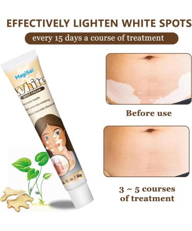  MagiSel Cream to repair white spots and pigmentation disorders hypoallergenic skin cream and pigment gel for skin with white spot disease promotes an even skin tone. - Buy Online on GoSupps.com
