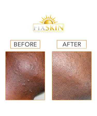 Razor Bump Removal Duo - Fast & Effective International Shipping | Smooth Skin Solution - Buy Online on GoSupps.com