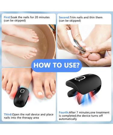 Nail Fungus Laser Treatment Device for Home Use | Effective Onychomycosis & Fungal Removal with 470nm Blue 660nm Red & 905nm Infrared Light - Buy Online on GoSupps.com