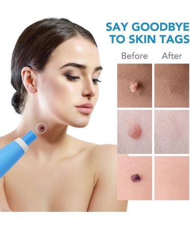 JIAWEIIY 2-in-1 Auto Skin T_ag Removal Kit for Skin T_ag (2-8mm) Skin T_ag Remover Device for Skin T_ags Fast and Easy Skin T_ag Remover Pen Device - Buy Online on GoSupps.com