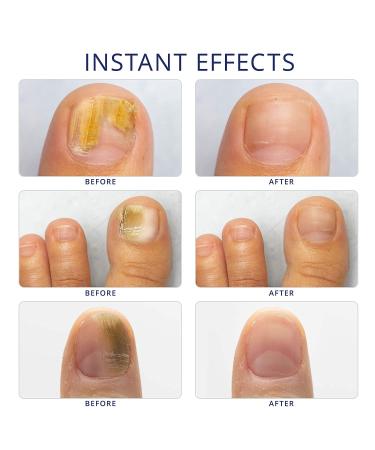 Extra Strength Toe Nail Fungus Treatment - Nail Repair Solution for Damaged Nails - Buy Online on GoSupps.com
