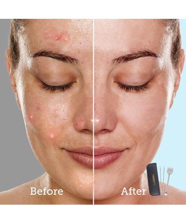 LitBear Pore Prep Tool | Blackhead Remover & Pimple Popper Kit | Stainless Steel Extraction Tool for Acne, Whitehead, Blemish & Comedone - Buy Online on GoSupps.com