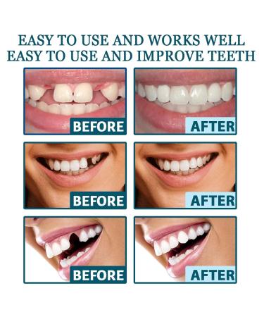 Adjustable Snap-On Denture Teeth Gap Filler & Straightener Kit Easy To Use Seamless Fit Comfortable Wear(3PC) - Buy Online on GoSupps.com