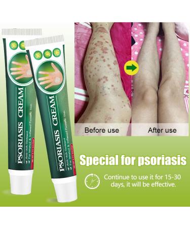  MagiSel Ringworm cream soothing anti-itch cream ready-to-use cream body cream for redness and itching relief skin itching relief - Buy Online on GoSupps.com