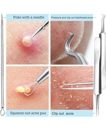 Acne Removal Tweezers Comedones Set Stainless Steel Acne Extraction Tool for Women and Men - Buy Online on GoSupps.com
