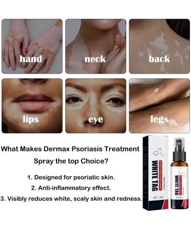 Dermax Psoriasis Treatment Spray Psoriasis Treatment Spray Kolmax Psoriasis Relief Spray Scalp Psoriasis Treatment Spray 30ml Psoriasis Treatment Spray (2 PCS) - Buy Online on GoSupps.com