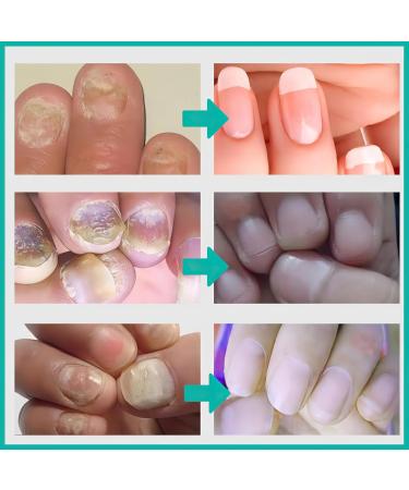 MIELIKKI Nail Repair Cream - Strengthen & Repair Damaged Nails | Nail Strengthener & Solution for Cracked & Discolored Nails - Shop Now - Buy Online on GoSupps.com