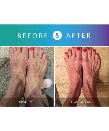 Prosoria Psoriasis Treatment System - Clinical Strength with Natural Botanicals | Soften, Restore & Treat Skin | 2 Fl Oz (Pack of 2) - Buy Online on GoSupps.com