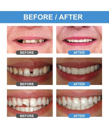 Temporary Tooth Repair Kit for Missing and Broken Teeth - Fake Teeth Replacement - Buy Online on GoSupps.com