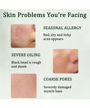Tea Tree Acne Cream 50g - Spot Cream for Acne & Pimple - Dark Spot Remover for Face - Blackhead Remover Cream - Skin Care Face Cream for Women - Oil Control Soothing and Moisturizing Pimple Cream - Buy Online on GoSupps.com