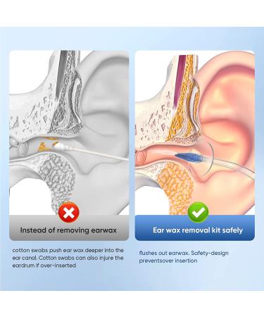WEUANY Ear Wax Removal Kit - Safe & Effective Manual Ear Irrigation Flushing System - Buy Online on GoSupps.com