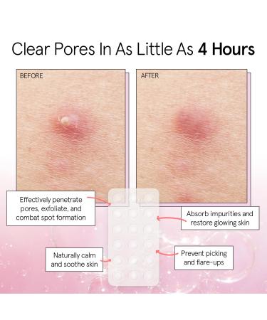 Grace & Stella Pimple Patches for Face - 72 Hydrocolloid Acne Patches | Vegan & Cruelty-Free Blemish Stickers Dermatologist Tested - Buy Online on GoSupps.com