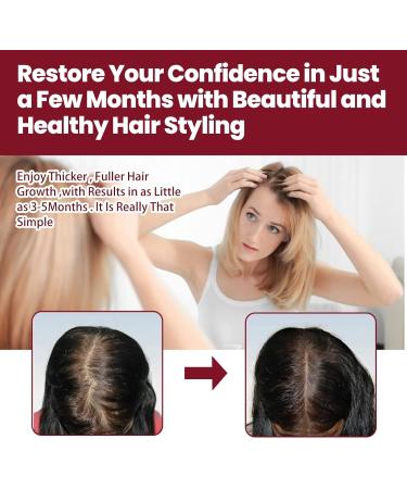 JITASHWA Hair Growth Foam Hair Regrowth Treatment for Women & Men Hair Regrowth Scalp Foam Hair Loss Solution Hair Thickening Product - Buy Online on GoSupps.com