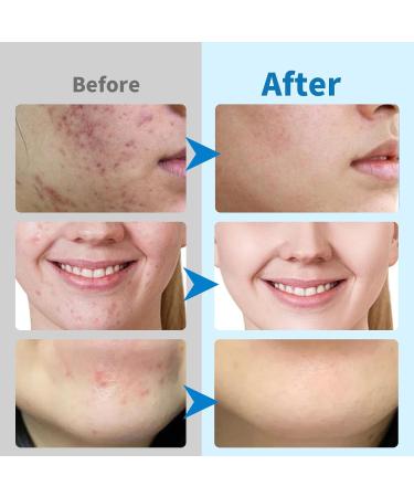 Glycolic Acid Pads 2PCS 10% Advanced Pure Glycolic Acid & 2% Salicylic Acid Exfoliating Peel 80 Pads for Face with Deep Cleaning Effect Reduces Blackheads Keeps Skin Smooth - Buy Online on GoSupps.com