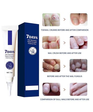 7 Days Nail Recovery Growth Essence Pen - Strengthening Serum for Thin Nails | Fast Nail Repair Solution - 1 PC - Buy Online on GoSupps.com