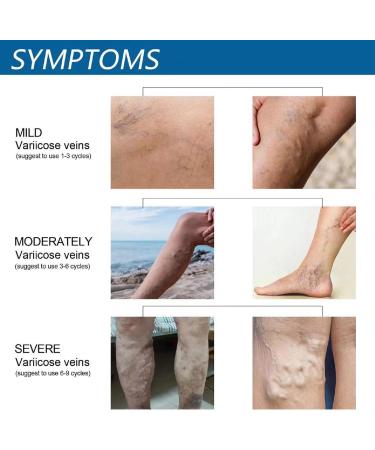 Varicose Veins Cream Spider Vein Cream Varicose Veins Treatment for Legs Spider Veins Treatment Cream Vein Cream for Legs Spider Veins Repair Cream Varicose Veins Ointment Aching Legs Relief - Buy Online on GoSupps.com