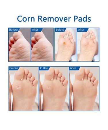 Gelanori Corn Removers - Foot Care Corn Pads (10 pcs) for Feet and Toes - Buy Online on GoSupps.com