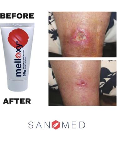 Sanomed Melloxy Wound & Healing Ointment 20G - Natural Gel for Acute Wounds Eczema & Fissures with Medical Honey & Ozonized Olive Oil - Buy Online on GoSupps.com