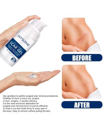 Scar Gel Cream for Surgical Scars C-Section Stretch Marks Acne Burns & Keloids - Effective Treatment for Old & New Scars - Buy Online on GoSupps.com