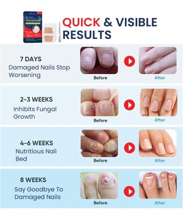 Extra Strength Toenail Fungus Treatment - Nighttime Patches for Nail Repair & Fungal Care (20 Count - Buy Online on GoSupps.com