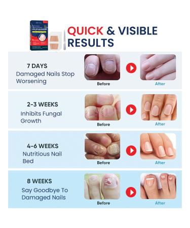 Extra Strength Multi-Purpose Fungus Nail Patches | Effective Toenail & Ingrown Toenail Treatment | Nighttime Fungal Nail Solution - Buy Online on GoSupps.com