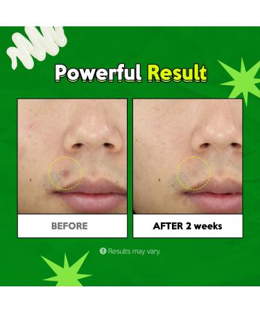 Troubless Clear Gel Cream 0.5Fl Oz - Soothing Acne Treatment with Tea Tree | Korean Skin Care for Clear Skin - Buy Online on GoSupps.com