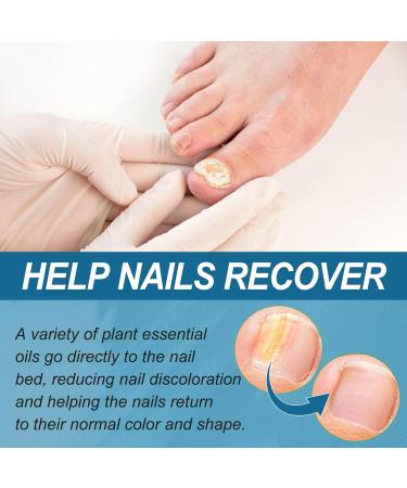 Nail Fungal Treatment Nails Essence Liquid Toenail Treatment Extra Strong Nail Repair Fingernail Toenail Care Fix Renew Damaged Broken Anti Fungus Nail Repair 30ML - Buy Online on GoSupps.com