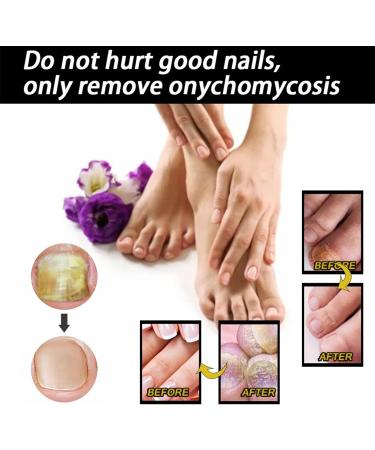 Nail Liquid Thickening Shiny Nails Grey Nails Dead Skin Moisturising Nail Nutrition Care Liquid 30ml 50ml CnJ78 (B One Size) 1 count (Pack of 1) b - Buy Online on GoSupps.com