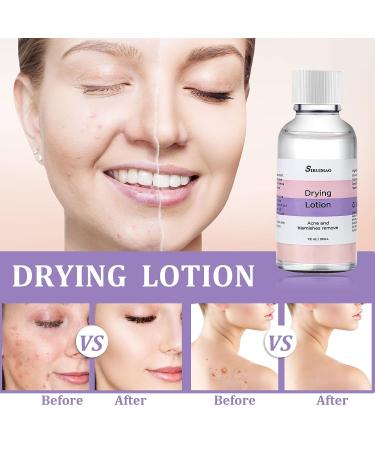 SIRUIMAO Stubborn Acne Drying Lotion - Overnight Acne Spot Treatment for Face & Body - 1 Fl Oz (Pack of 1) - Buy Online on GoSupps.com