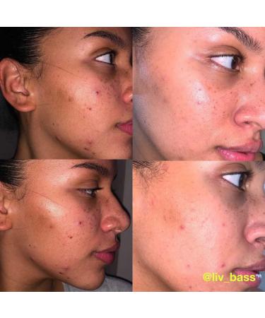 Carbon Theory | Tea Tree Oil & Glycolic Acid Exfoliating Breakout Control Cleansing Pads | Natural Vegan And Cruelty Free | 60 Pads - Buy Online on GoSupps.com